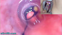 Mature Woman Peehole Endoscope Camera in Bladder with Balls