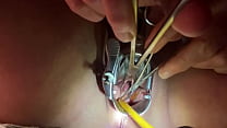 Tenaculum grasping cervix for catheter
